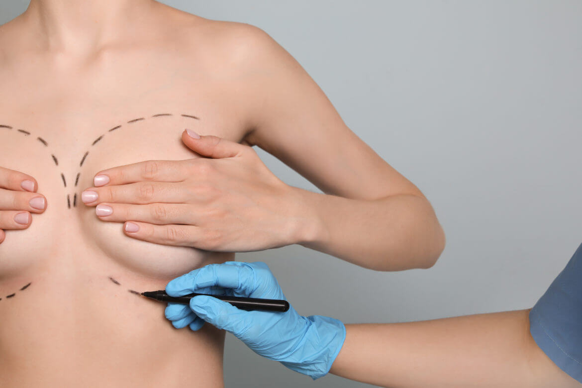 Using Liposuction for Fat Transfer Breast Augmentation